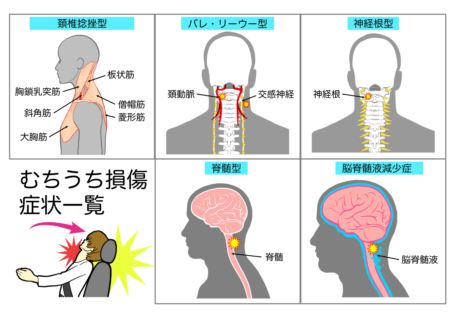 むちうち損傷の症状一覧(頚椎捻挫型・バレ–リーウー型・神経根型・脊髄型・脳脊髄液減少症)